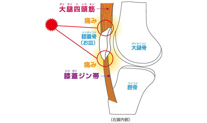 ジャンパー膝（膝蓋腱炎（靱帯炎））