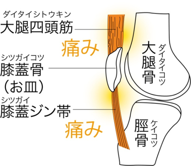 ジャンパーひざ(膝蓋ジン帯炎)