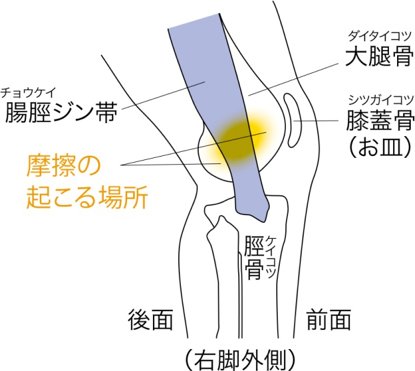 ランナーひざ(腸脛ジン帯炎)