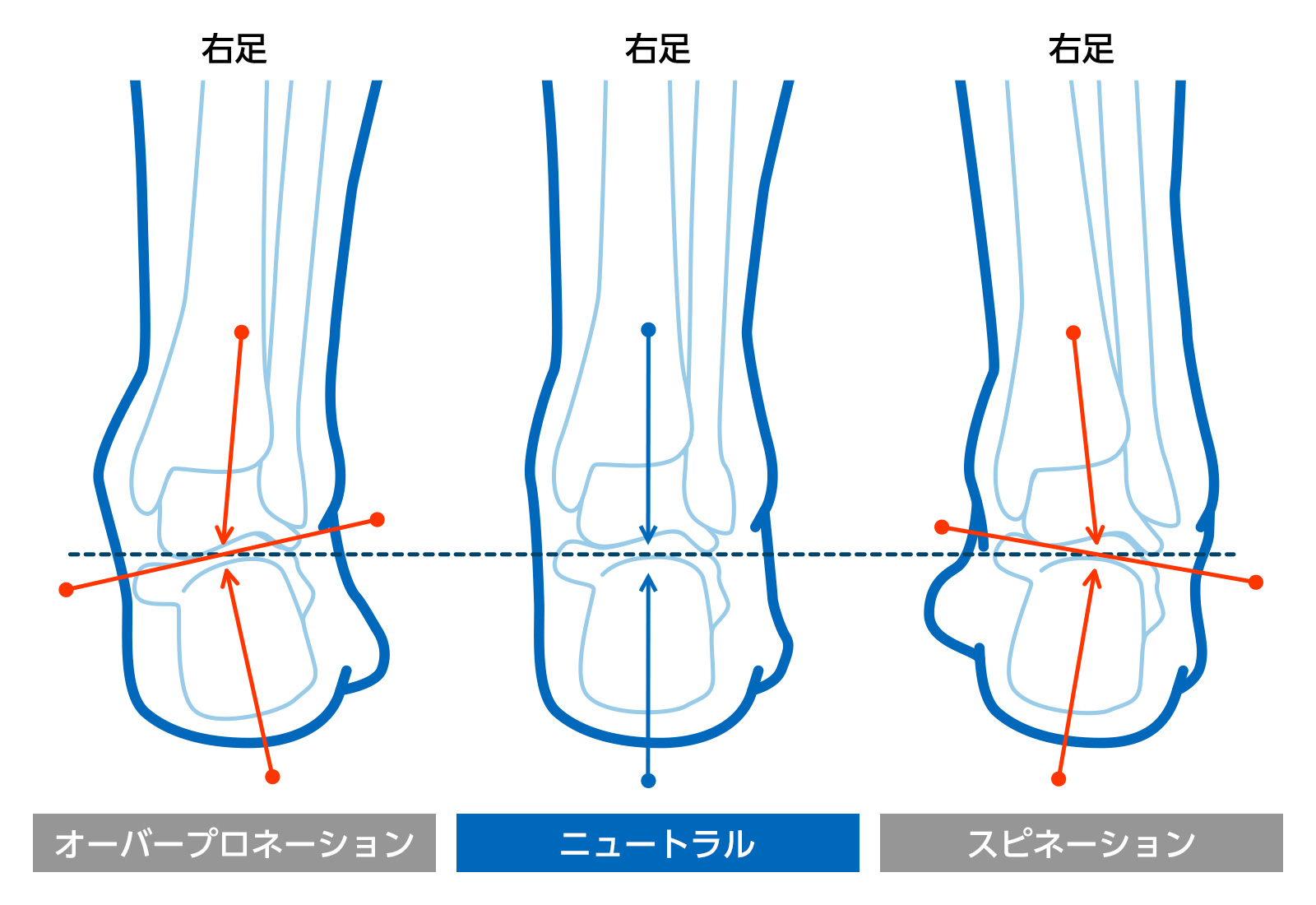 足部のアライメント比較図