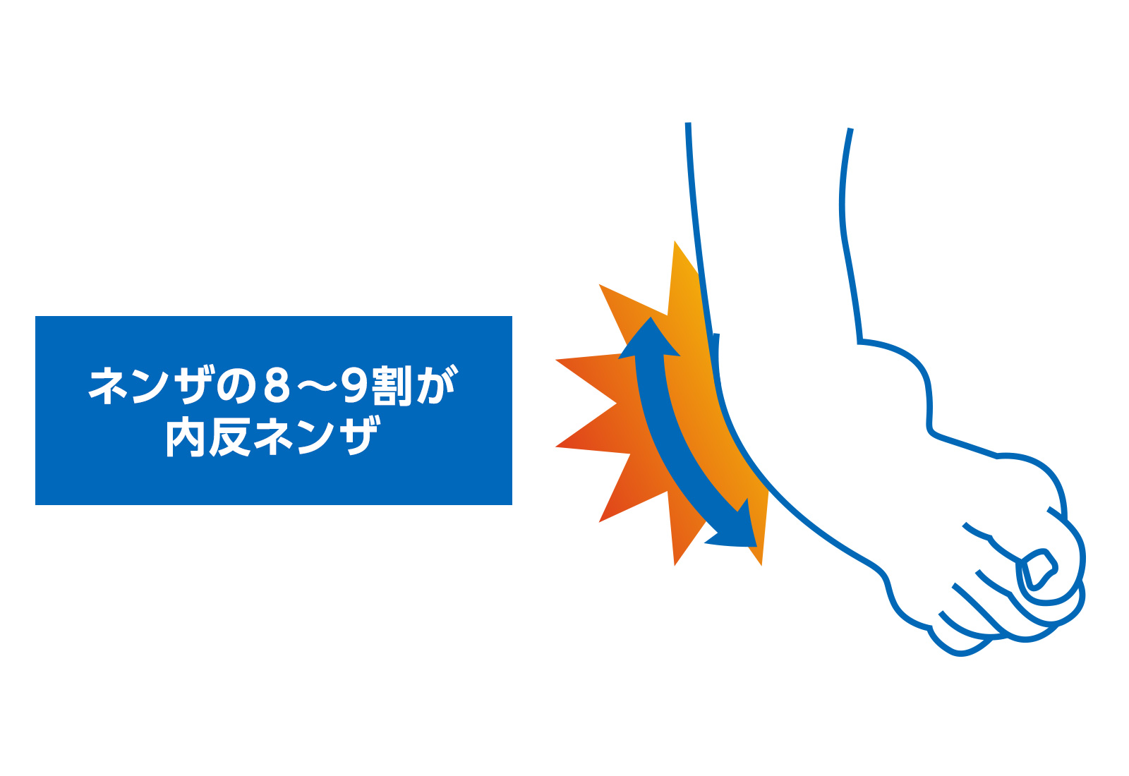 ネンザの8～9割が内反ネンザ