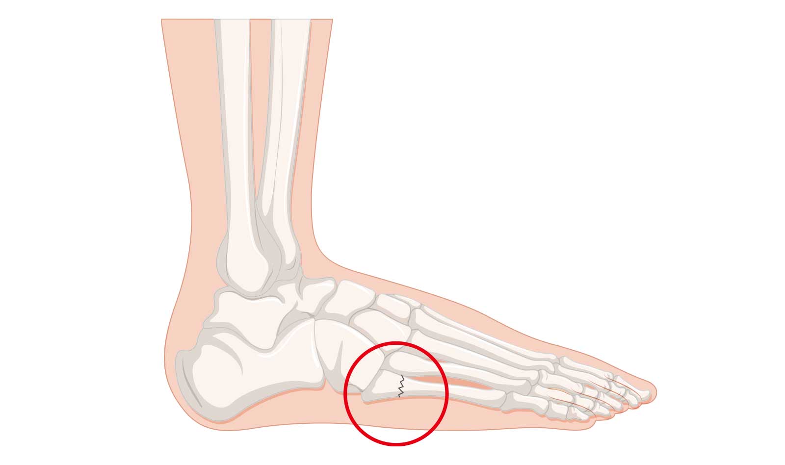 ジョーンズ骨折（第５中足骨疲労骨折）