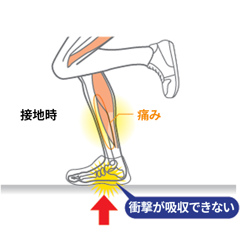 図1:接地時の痛み