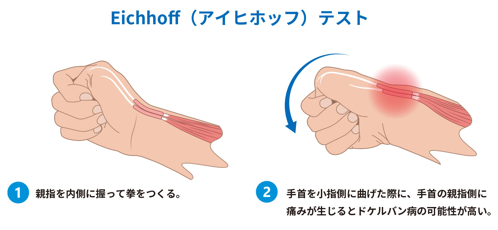 腱鞘炎・ドケルバン病｜手首の親指側の痛みを感じたら ザムスト公式オンラインショップ｜スポーツ用サポーター・インソール・ソックスなど