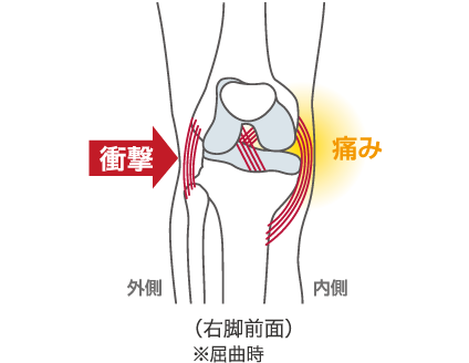 内側側副靭帯損傷（MCL）