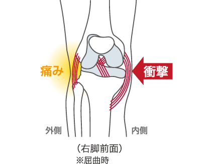 外側側副靭帯損傷（MCL）