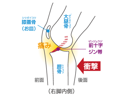 前十字靭帯損傷