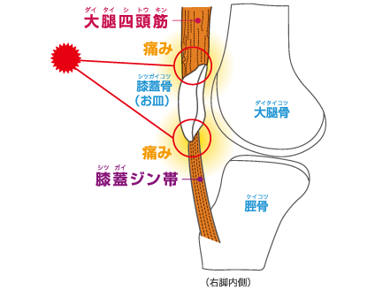 膝蓋ジン帯炎