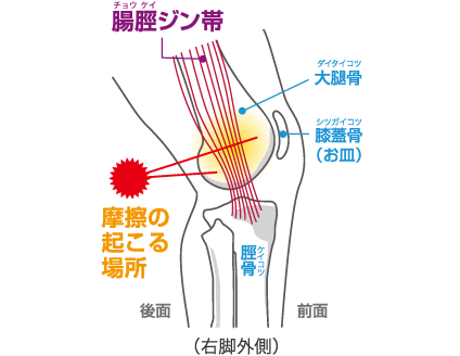 腸脛ジン帯炎（ランナーひざ）