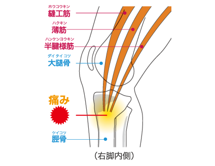 鵞足炎