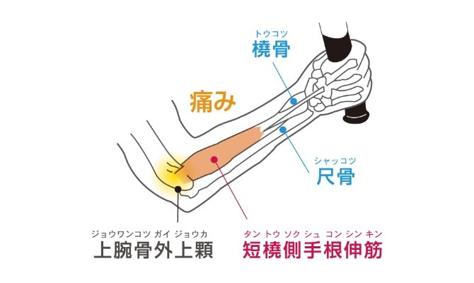 テニス肘（上腕骨外上顆炎）