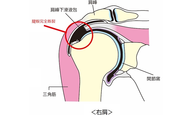 野球肩